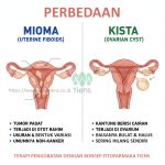 Perbedaan Miom dan Kista: Penyebab, Gejala, dan Terapi Alami Dengan Konsep Fitofarmaka Tiens